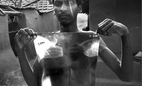 Tuberculosis Patient